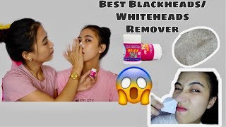 Murang Blackheads & Whiteheads Remover Gel Hut Mun White Twin Vlog