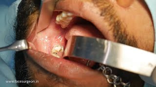 Surgical Wisdom Tooth Extraction by Specialist Oral Surgeon - Dr. Sunil Richardson