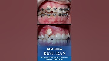 Quá trình thay đổi của răng khấp khểnh nhờ niềng răng mắc cài l Team niềng răng  #nhakhoauytin