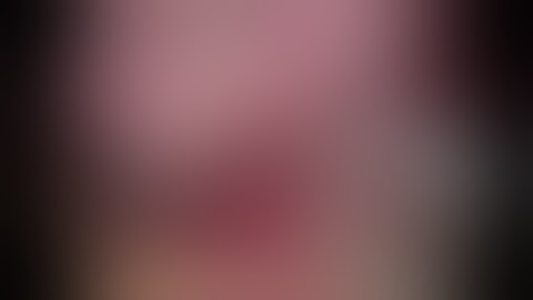 Sublobar resection:SP VATS right S5 anatomic segmentectomy