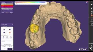 Exocad Design Guide Single Crown Posterior