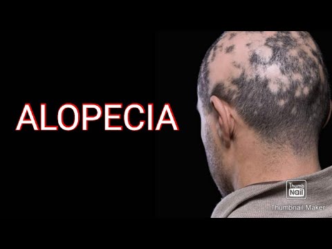 Video: Alopecia Barbae: Penyebab, Gejala, Dan Perawatan