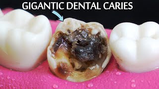 INCREDIBLY SATISFYING Restoration Of Massive Tooth Decay | Root Canal And Crown Process. screenshot 3