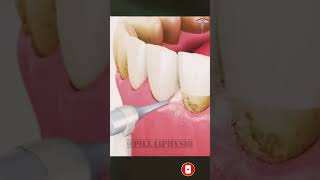 Teeth Whitening Procedure  shorts shortvideo shortsfeed