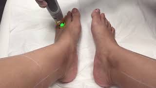 Laser Hair Removing On Feet And Toes