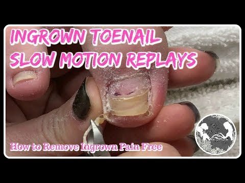 THICKENED AND DEFORMED MIDDLE TOENAIL TREATMENT 