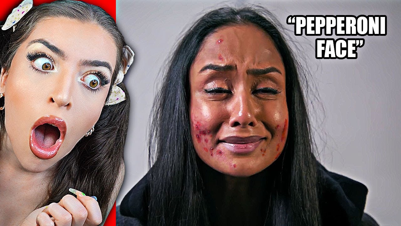 Mean Kids SHAME Girl With Acne.. What's Next Is Shocking