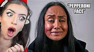 Details Mean Kids SHAME Girl With Acne.. What's Next Is Shocking Guide