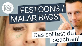 Was sind FESTOONS bzw MALAR BAGS und wie behandelt man sie?! Dr. Rolf Bartsch erklärt