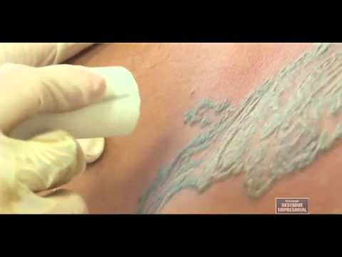 remover tatuagem método caseiro