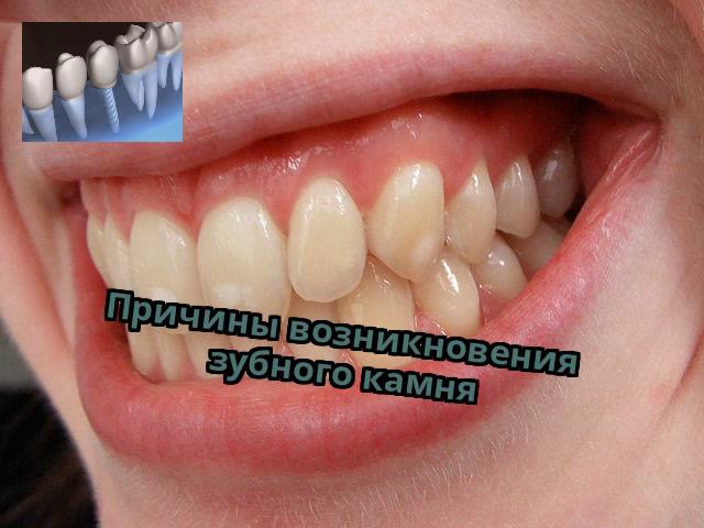Причины возникновения зубного камня