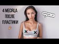 ЖИЗНЬ ПОСЛЕ МАММОПЛАСТИКИ | 🔞 ОТВЕЧАЕМ НА ВОПРОСЫ С ХИРУРГОМ