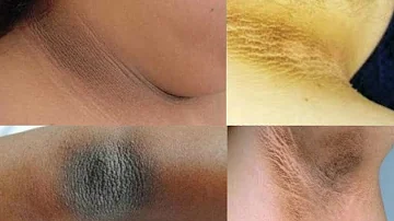 Qual o nome da doença que deixa o pescoço preto?