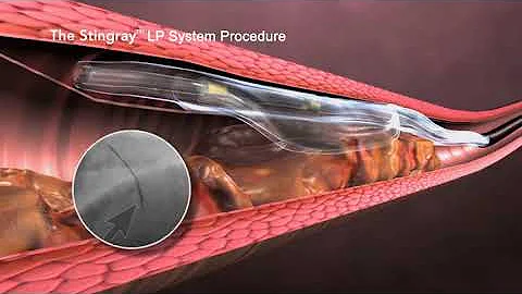 Boston Scientific Coronary CTO System Overview