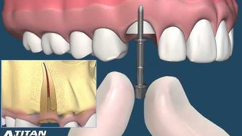 Easy X-Trac System by A. Titan Instruments