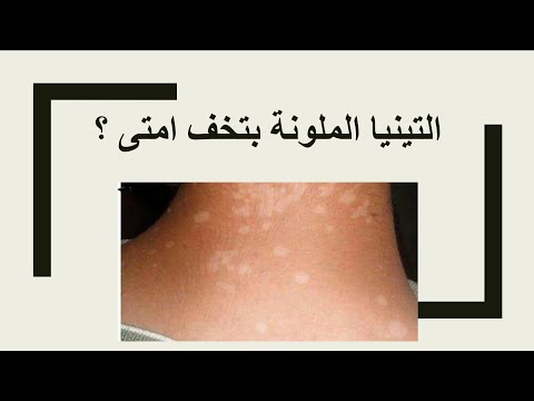 التنيا الملونة النخالة المبرقشة بتخف امتى وهل التينيا الملونة معدية  