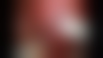 Right Sided Robotic Pyeloplasty