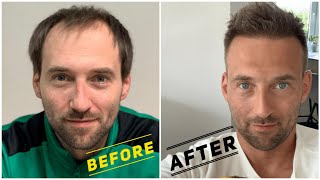 Hair Transplant Growth Timeline | Day 1 To Day 365 Before & After | FirstClass-Esthetic