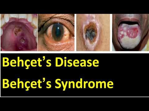 Behçet’s syndrome symptoms signs