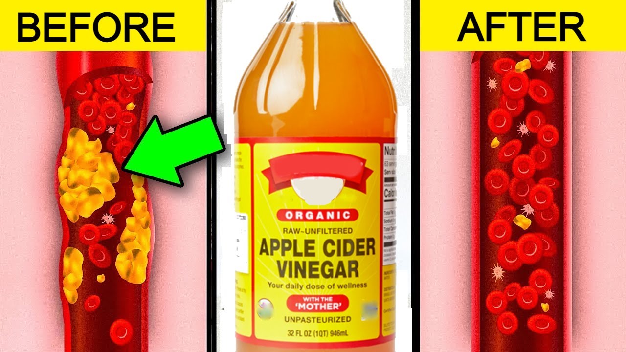 Can Apple Cider Vinegar Help You Lose Weight? 5 Proven Health Benefits