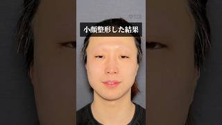 【糸リフト】小顔整形した結果#shorts