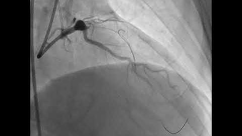 Angioplasty technique: Reverse wire technique