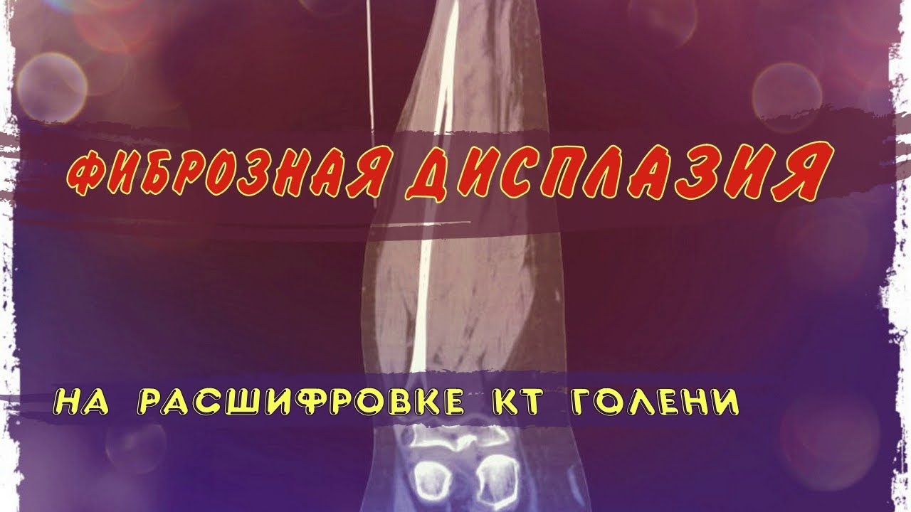 ФИБРОЗНАЯ ДИСПЛАЗИЯ большеберцовой кости (образование овоидной формы) на РАСШИФРОВКЕ КТ голени