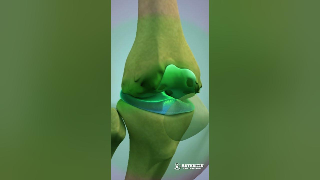 fda-approved-gel-visco-supplement-knee-injections-help-you-avoid