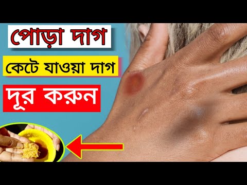 ভিডিও: পোড়া দাগ দূর করার 3 টি উপায়