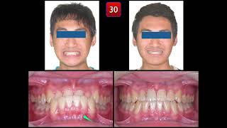 Solving Class III Malocclusion with Anterior Crossbite｜【Chris Chang Ortho】CC723