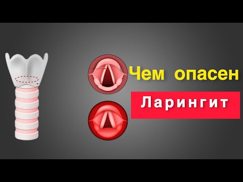 Чем опасен Ларингит у детей. Что делать при ларингите.
