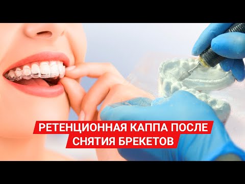 Изготовление капы после снятия брекетов