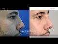 Повторная ринопластика от Кобулашвили Т. Г.: коррекция формы носа и восстановление функции дыхания