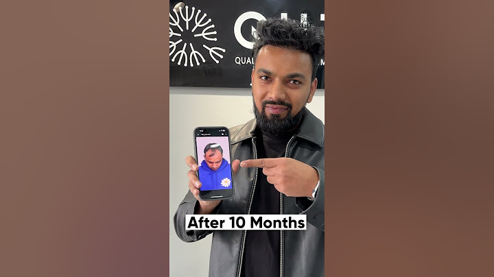Ten Months Hair Transplant Results | Latest Fue Technique #shorts #viral #hair transplant