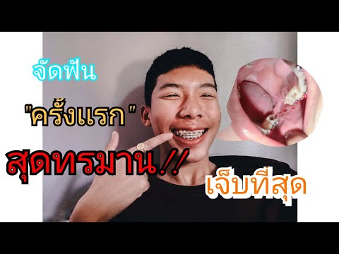 จัดฟันวันเเรก!! #กินอะไรไม่ได้ #เจ็บ #ทรมาน #สุด