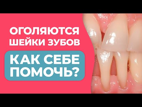 Оголяются КОРНИ ЗУБОВ? / РЕЦЕССИЯ ДЕСНЫ — причины и современные методы лечения / Опущение десен