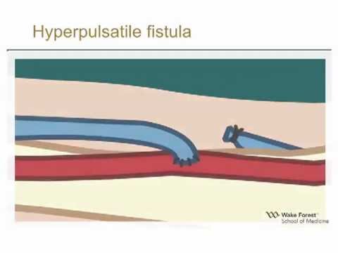 Video: Arteriovenous Fistula - Symptoms, Treatment, Forms, Stages, Diagnosis