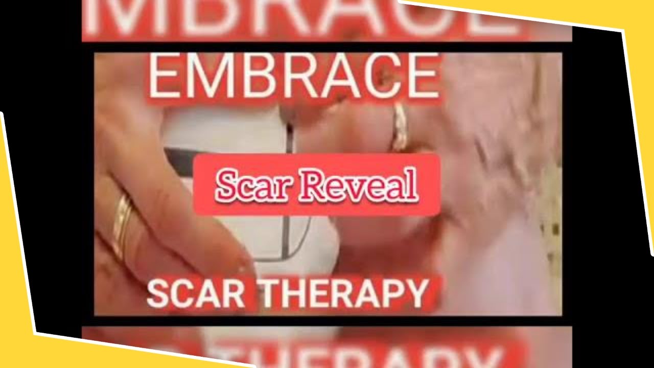 Embrace Scar Therapy !!!  TUMMY TUCK  SCAR !! 20 Day after use !! Body Scar Reveal..