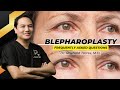 Blepharoplasty Philippines FAQ by Doc Ray Torres