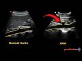 How to Diagnose: Abdominal Aortic Aneurysm (AAA) Ultrasound