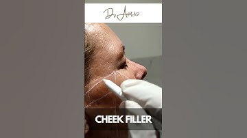 Mind Blowing Results of Cheek Fillers Treatment Done by Dr Ahmad