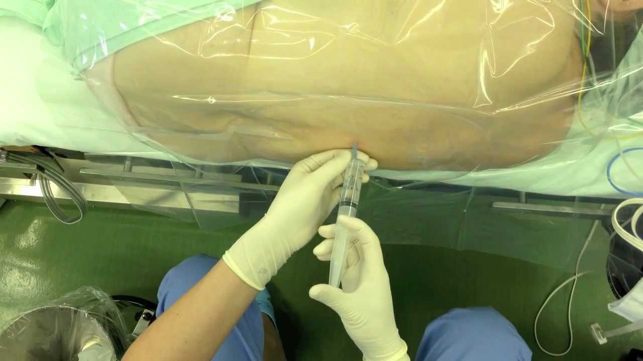 今週の硬膜外麻酔2例(頭上から撮影)epidural anesthesia by Dr.EpiCal YouTube