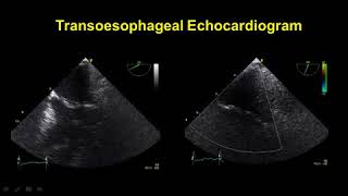 CARDIOGENIC PULMONARY OEDEMA AND ITS MANAGEMENT