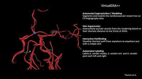 (TEASER) VirtualDSA++: Segmentation, Modelling and Interaction with the Cerebrovascular Vessel Tree