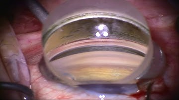 Dr. Gary Wörtz describes his pearls for new surgeons implanting the Hydrus Microstent