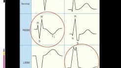 EKG Itu Gampang Sesi 6 (Latihan Aritmia Lanjutan) - Durasi: 23.35. 