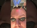 CO2 Laser Treatment of Sebaceous Hyperplasia