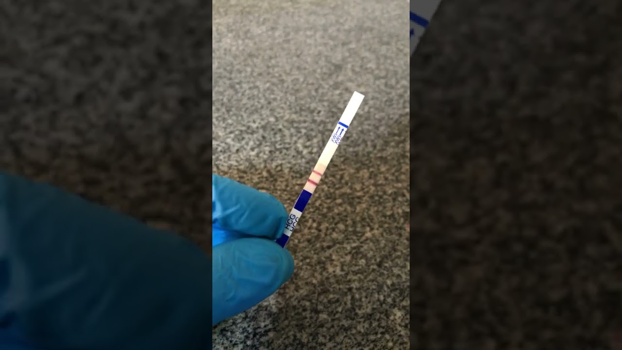 Beta-HCG Qualitativo (Exame de Gravidez) - Como Interpretar a Tira Reagente (Análises Clínicas)