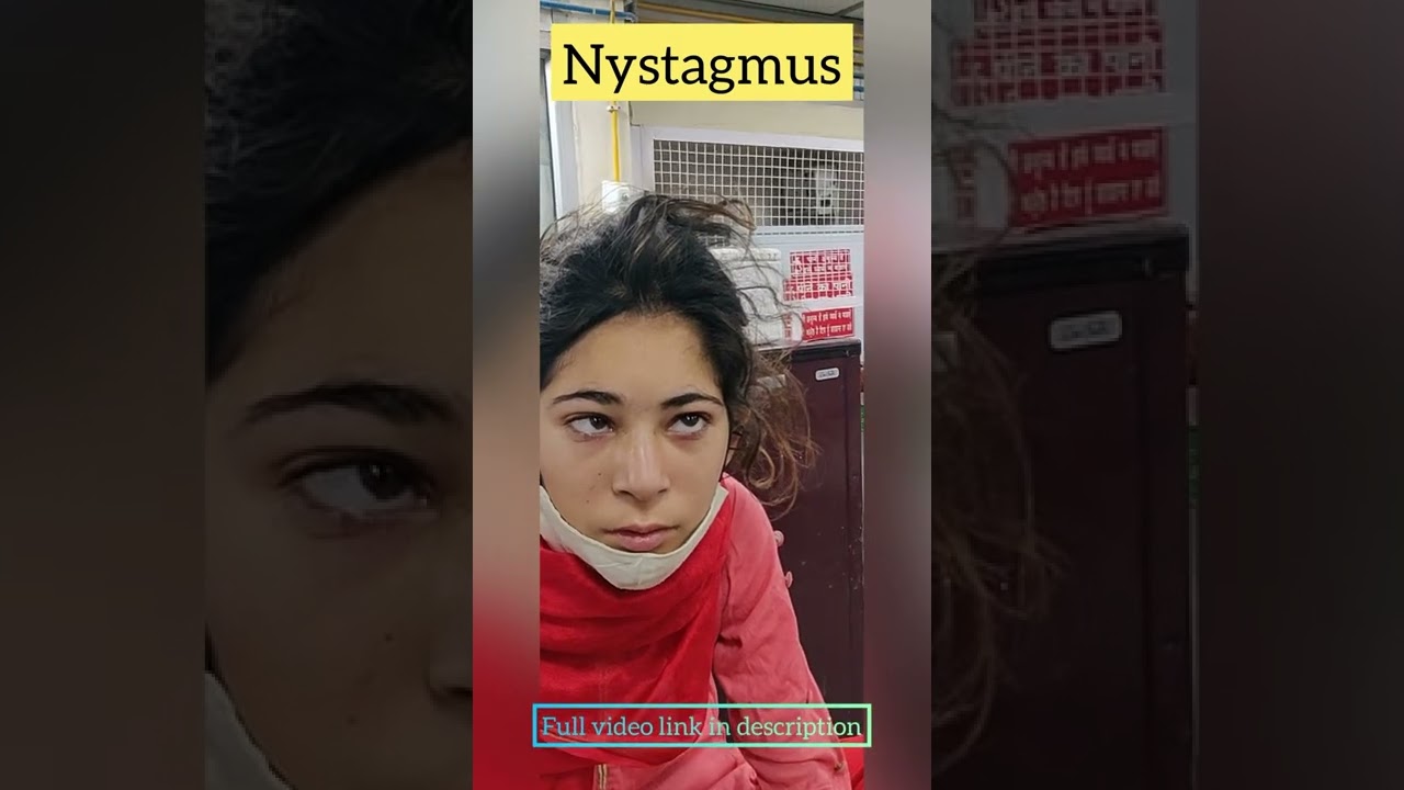 nystagmus seen in a patient I horizontal jerky eye movements l central nystagmus #neurology #shorts