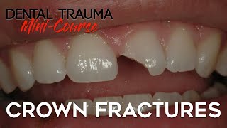 Dental Trauma Mini-Course - Part 4 - Dental Trauma Guide - Crown Fractures